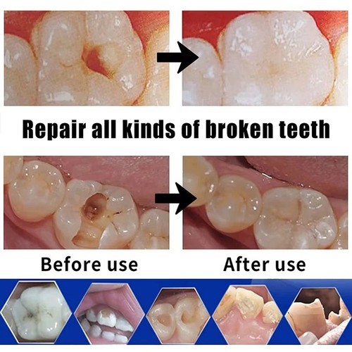 Dental cement teeth - cement,